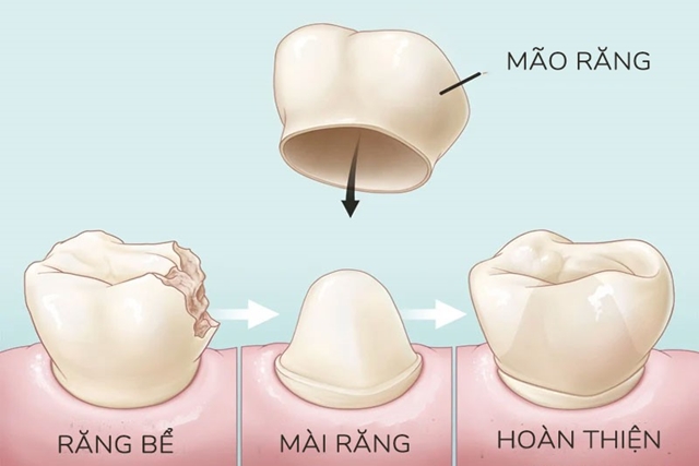 Cách nào hạn chế răng sứ xỉn màu?